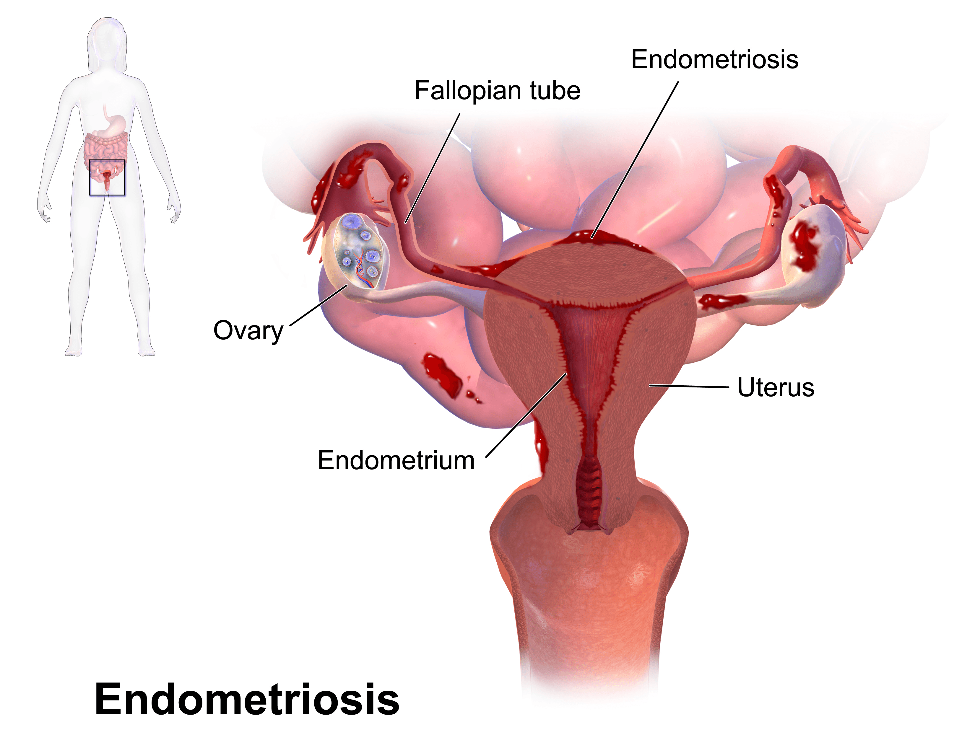 endometriosis-pain-location-11-natural-treatments-for-endometriosis